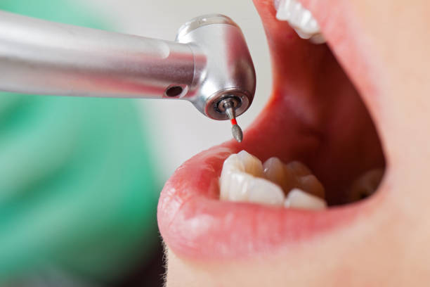 Best Emergency Wisdom Teeth Removal in Groesbeck, OH